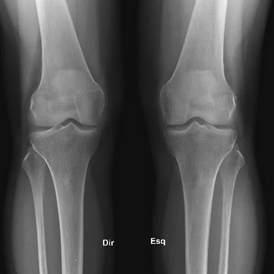 X-ray of the Right Knee AP View