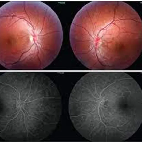 Leber Hereditary Optic Neuropathy