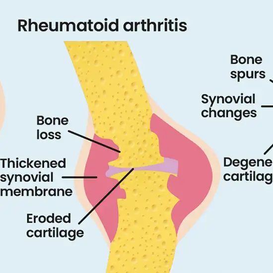 Rheumatoid Factor By Synovial Fluid- Book Test at Low Cost