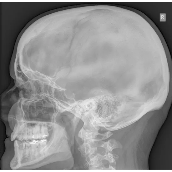 X-ray Mastoid AP View