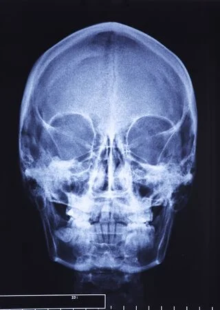 X-ray Maxilla AP & LAT View