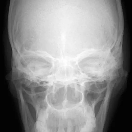 X-Ray Maxilla AP View