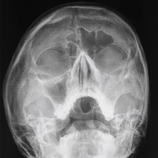 X-ray Maxillary Sinuses