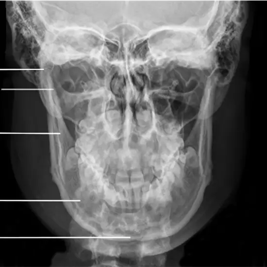 x-ray mandible both lateral/oblique
