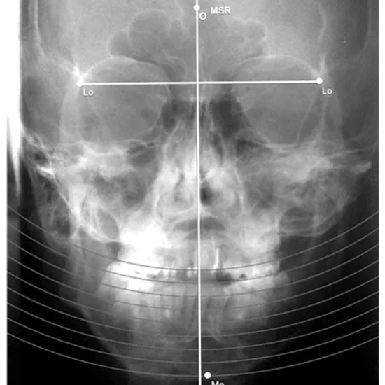 X-ray Mandible PA & Left LAT/Oblique