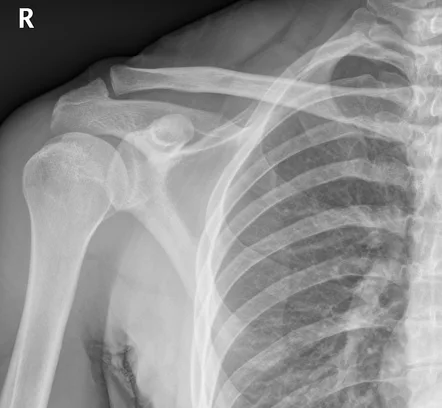 X-ray Left Shoulder AP & Axial