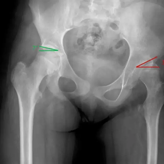 X-ray Left Upper Femur-Hip AP