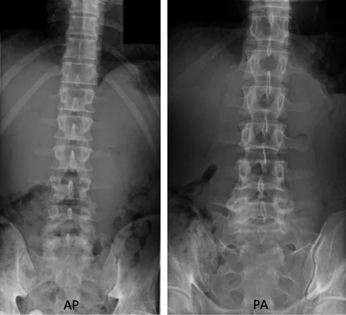 X-ray Lumbar AP & Lateral
