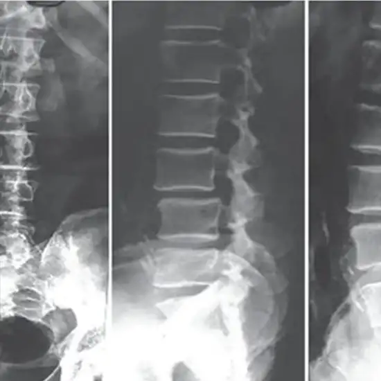 X-ray Lumbar Spine (AP/Lateral/Oblique)