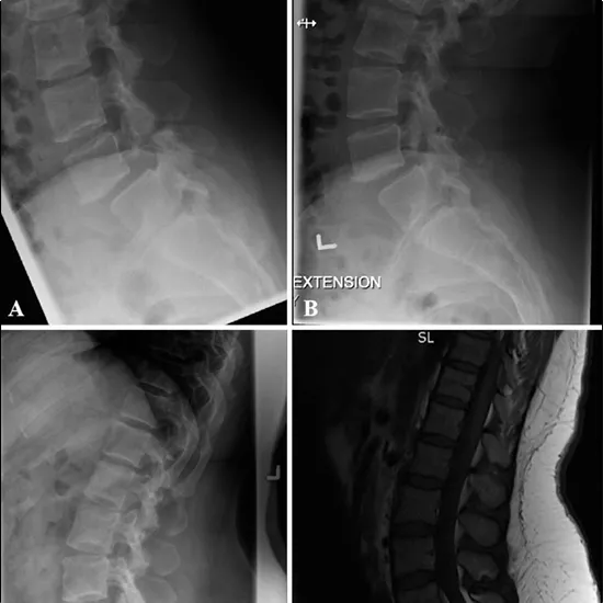 X-ray Lumbar Spine Extension