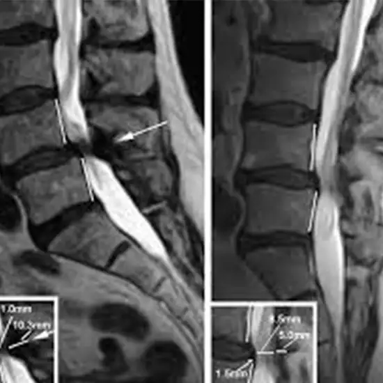 X-Ray Lumbar Spine Flexion