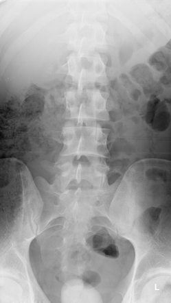 X-Ray Lumbosacral Spine