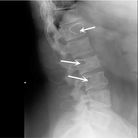 X-RAY Lumbar Spine Oblique View