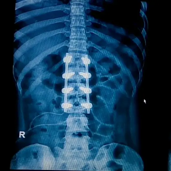 X-ray Lumbar Spine (LS) AP & Lateral