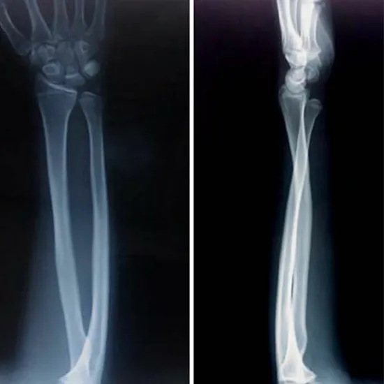 X-ray Left Arm AP & LAT
