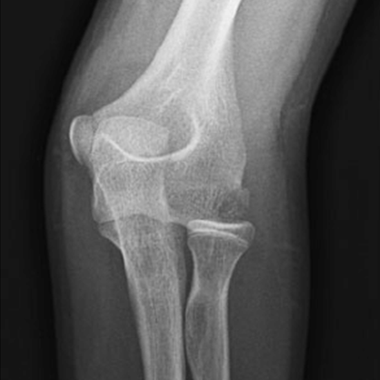 x-ray left elbow joint ap/lateral