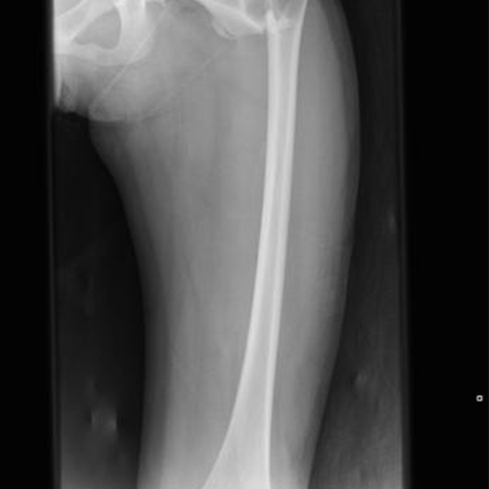 X-ray Left Femur AP/Lat