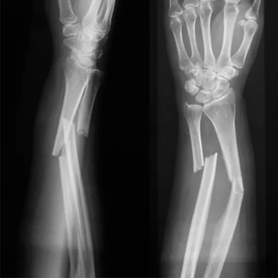 X-ray Left Forearm AP & LAT