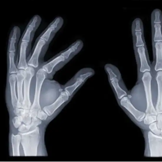 X-ray Left Hand AP & LAT