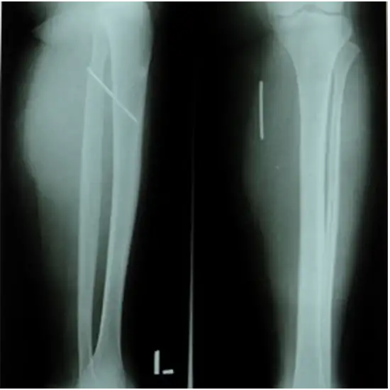 X-ray Left Leg AP & LAT