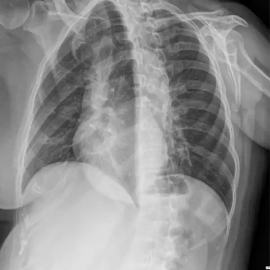 X-ray Lower Ribs Left