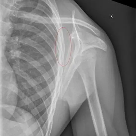 X-ray Left Scapula Lateral View