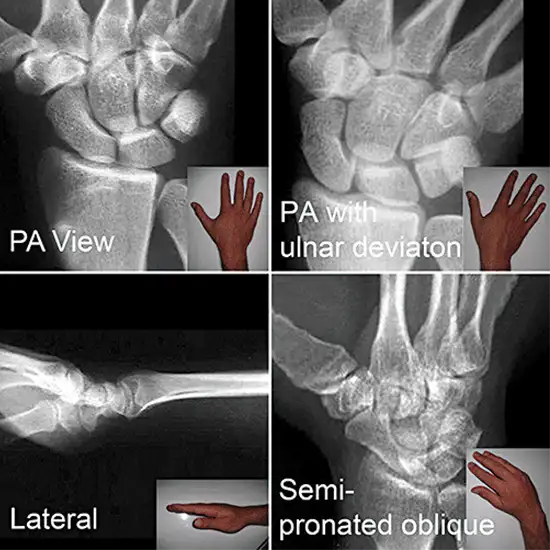 X-ray Left Scaphoid AP, LAT & Oblique Views