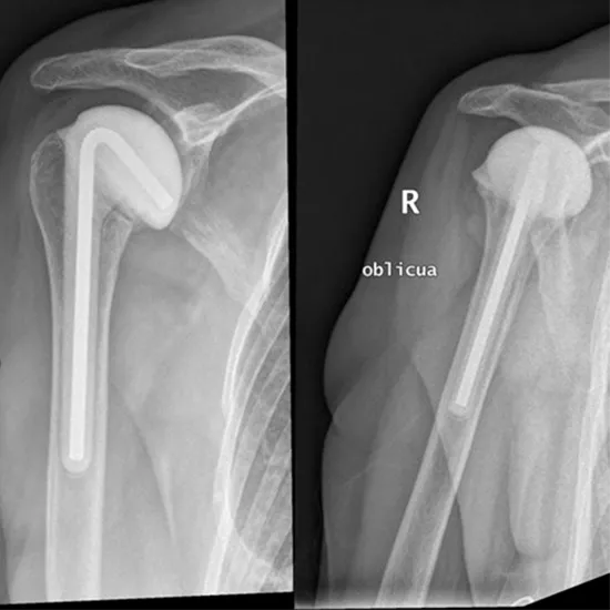 X-ray Left Shoulder Oblique