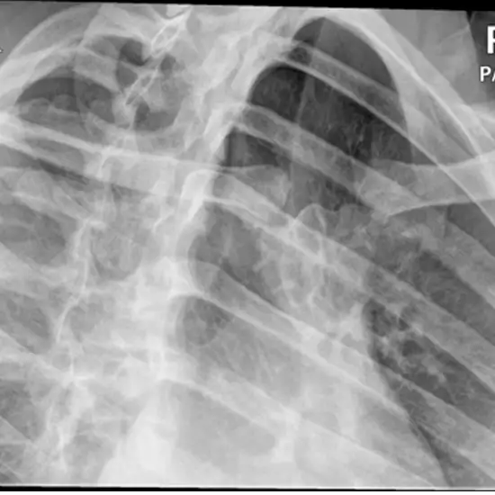 X-ray Left Sterno Clavicular Joint PA Oblique