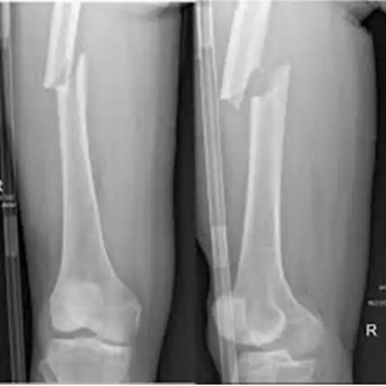 X-ray Left Thigh AP/Lateral