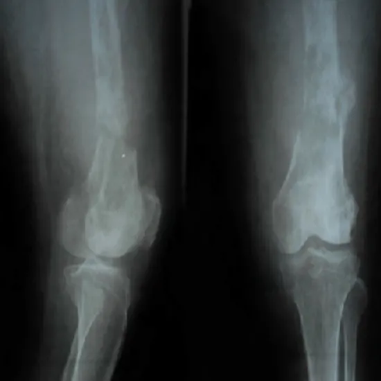 X-ray Left Thigh-Knee LAT