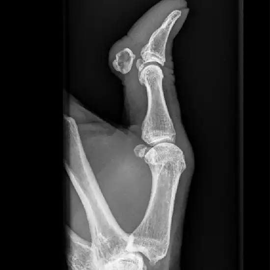 X-ray Left Thumb Lateral View