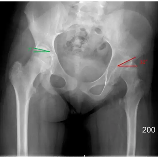 X-ray Left Upper Femur-Hip Lat