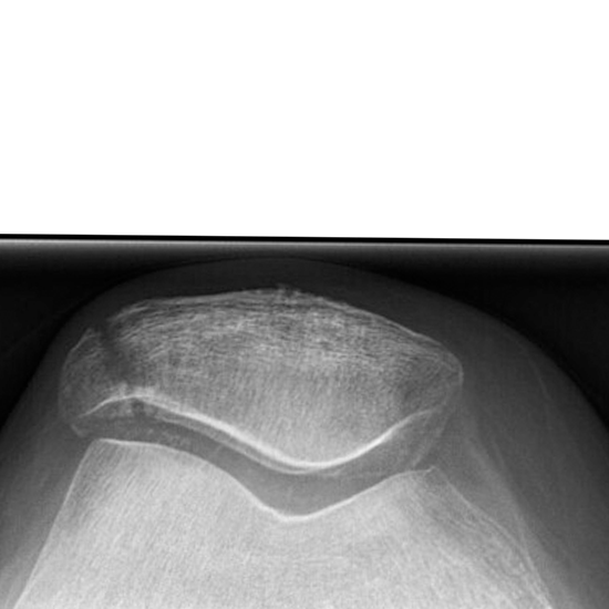 x-ray knee skyline view