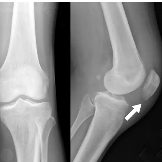 X-ray Knee AP/LAT View