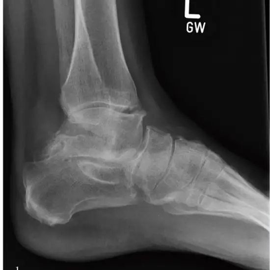 X-ray Left Ankle AP & Lateral