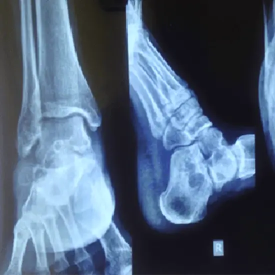 X-ray Left Ankle AP View