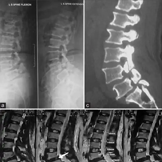X-ray Lumbosacral Spine AP/LAT/Extension/Flexion