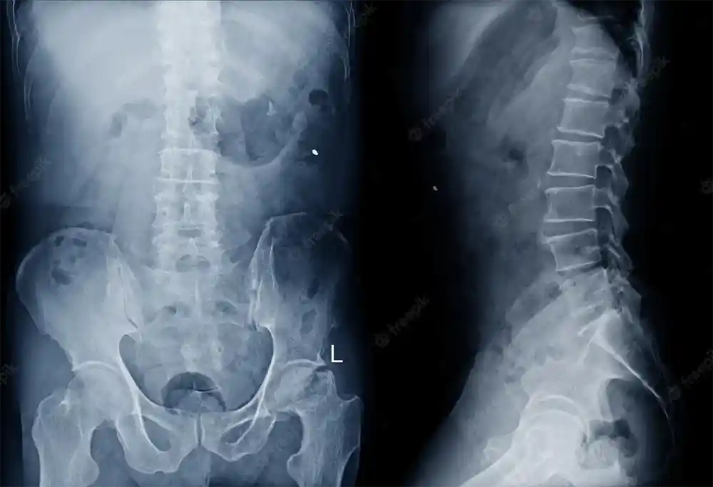 X-ray Lumbar Spine AP View