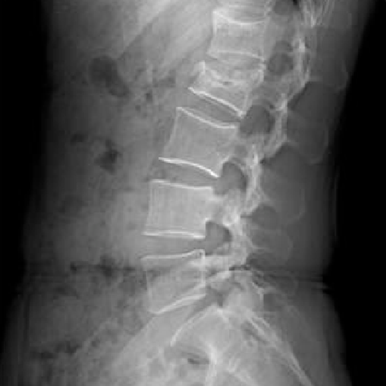 X-ray LS Spine Lateral