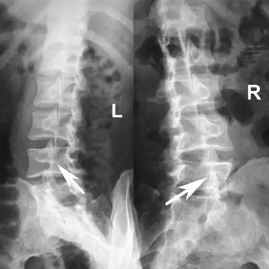 X-ray LS Spine Oblique