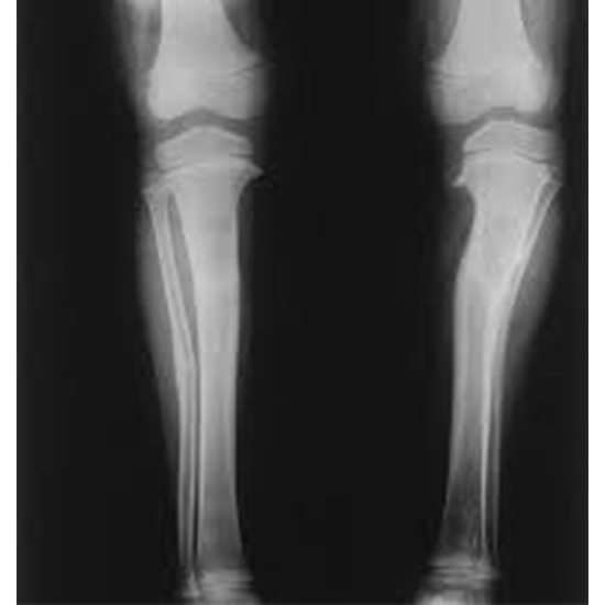 X-Ray Exam : Lower Leg (Tibia and Fibula)