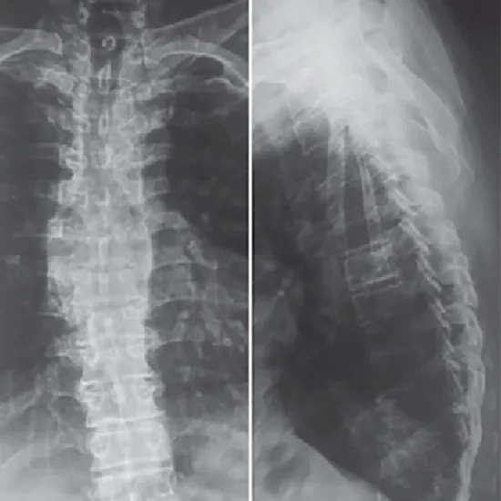X-ray Dorso Lumbar Spine AP View