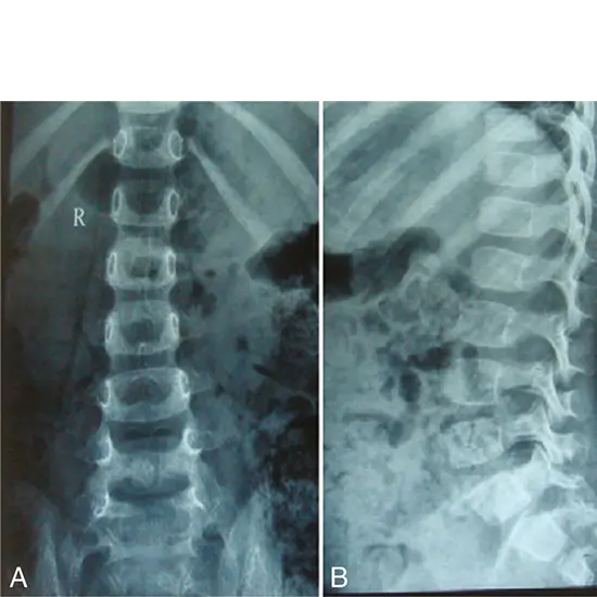 X-ray Dorso Lumbar Spine LAT View