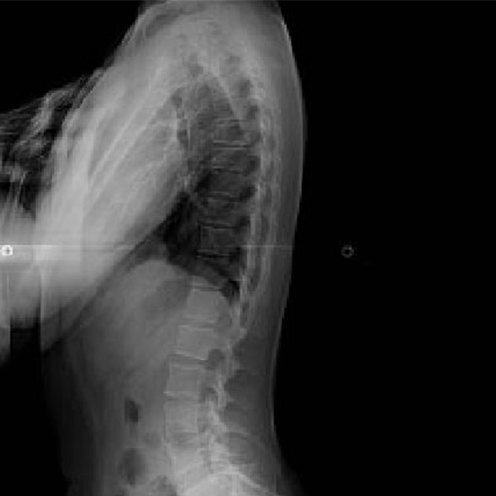 X-ray Dorsal Spine Lateral