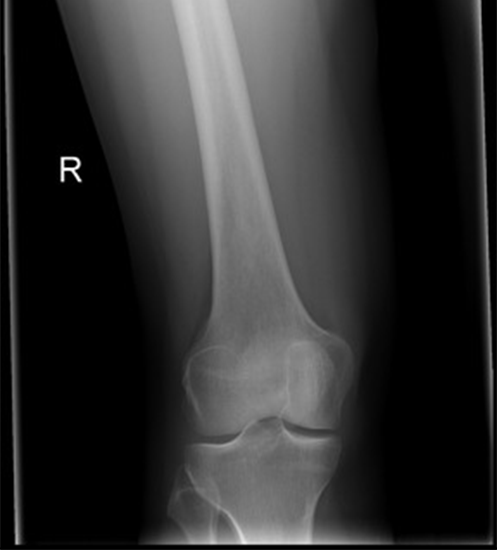 X-ray Femur AP/Lat