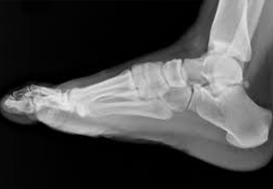 x-ray foot and ankle
