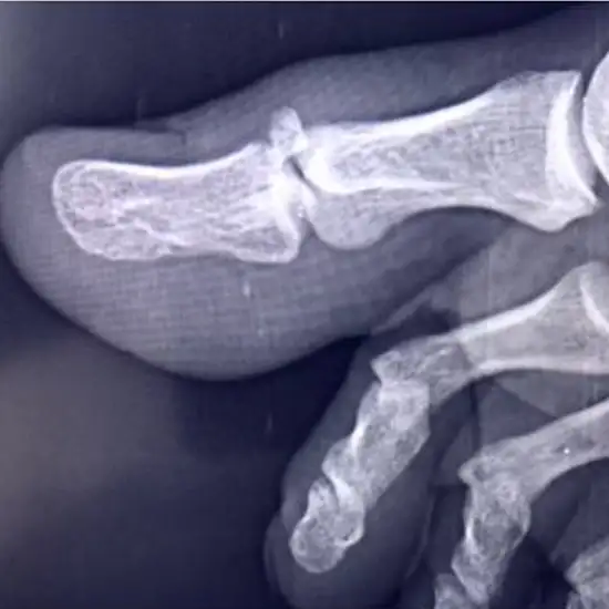 X-ray Great Toe LAT View