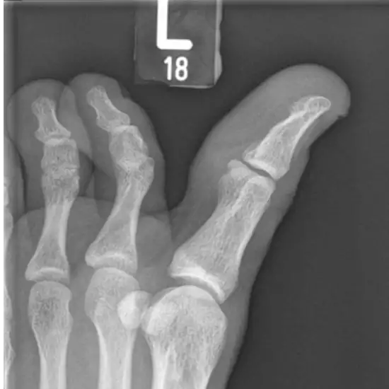 X-ray Left Big Toe AP & LAT