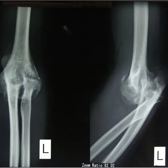 X-Ray Left Elbow Joint AP & Lateral View
